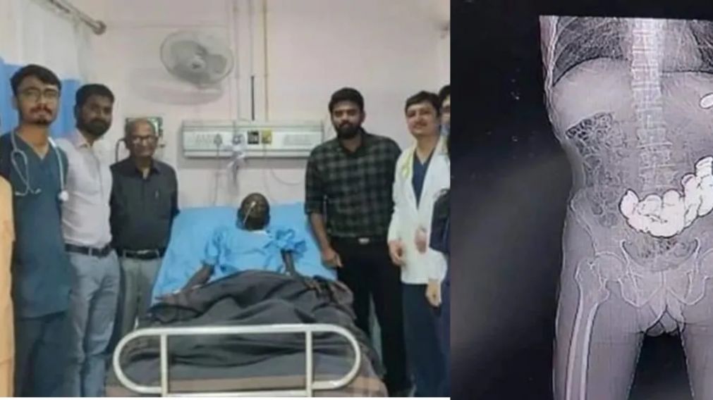 Un hombre fue al hospital por un fuerte dolor abdominal y encontraron un "tesoro" en su estómago.
