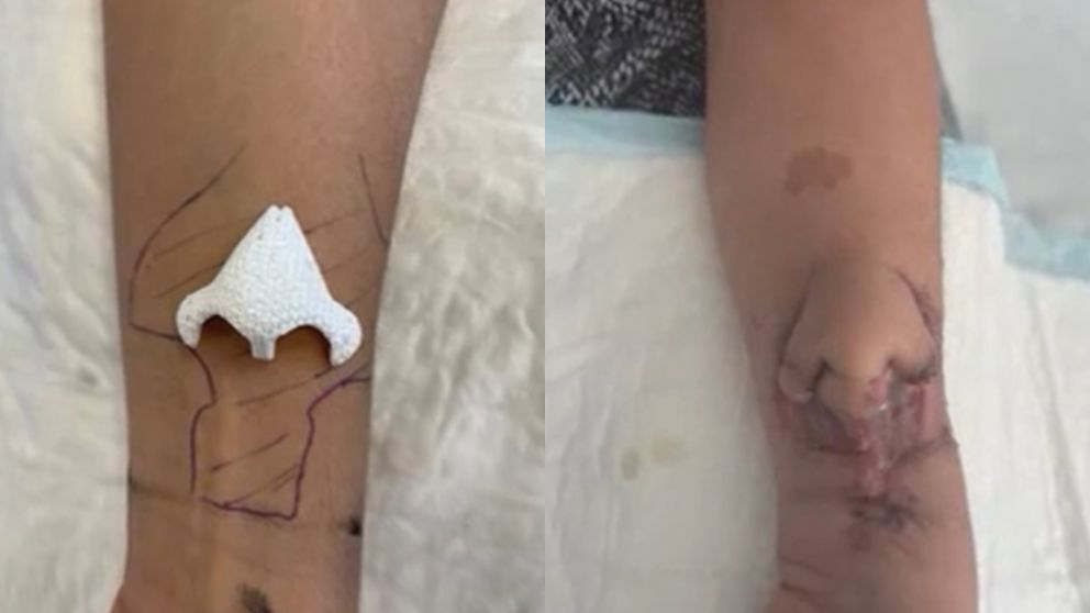 El proceso fue denominado como revascularización.