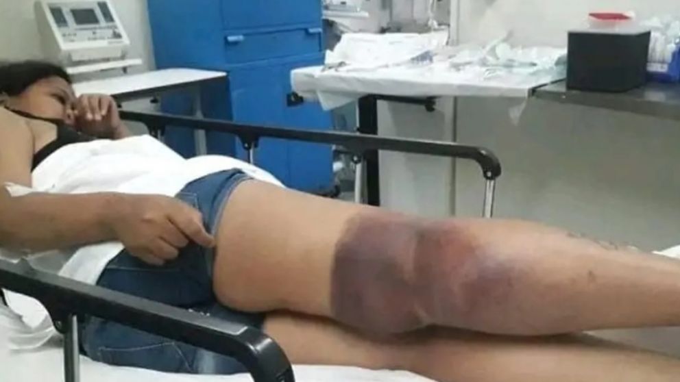 Al día siguiente del accidente la pierna de la joven se hinchó tanto que tuvo que regresar al centro médico (Foto: 0221)
