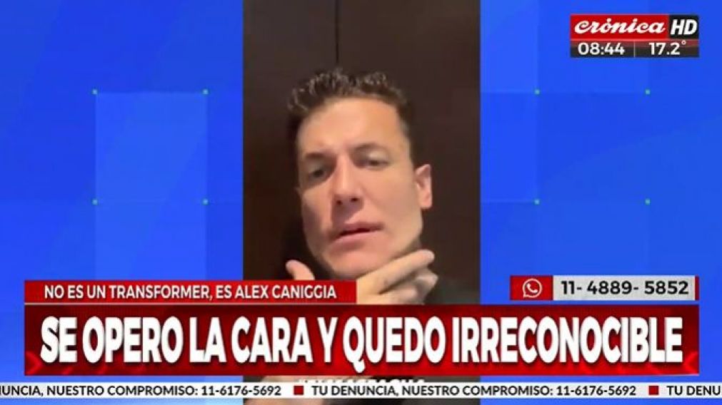 Alex Caniggia se operó la cara y quedó irreconocible