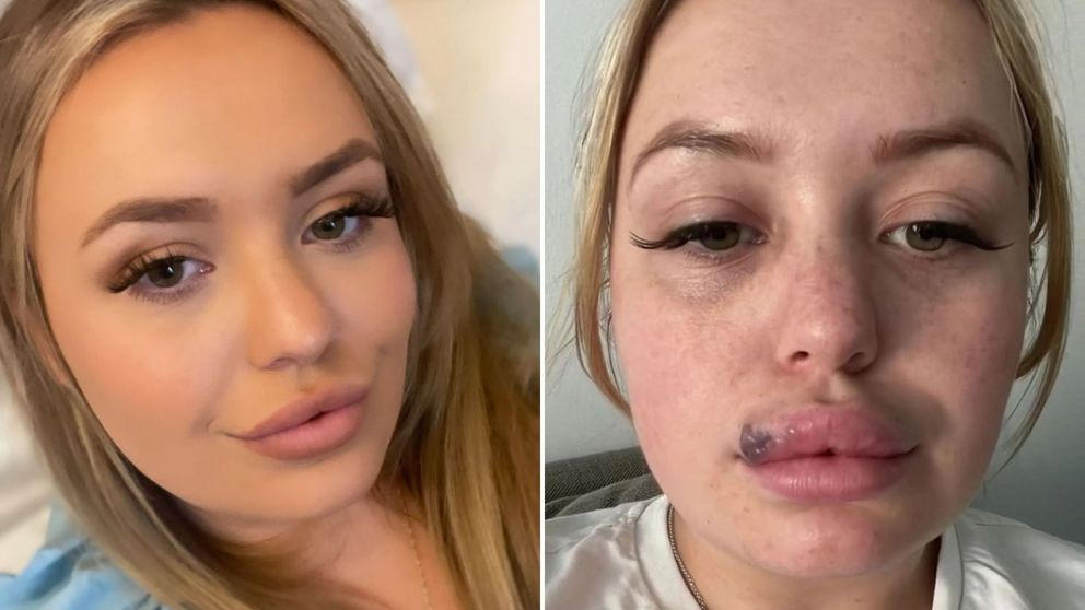 Se realizó una cirugía estética en sus labios y quedó desfigurada tras sufrir una reacción alérgica (Imagen Instagram).