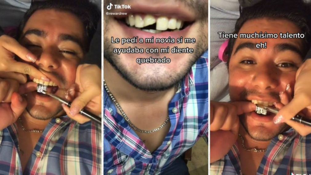 Se le quebró un diente y su novia encontró una solución casera que se volvió viral (Imagen captura vídeo).