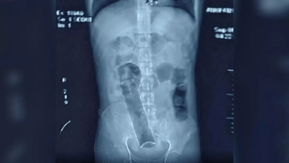 Estuvo 3 semanas con un desodorante en el ano y tuvieron que operarlo de urgencia.