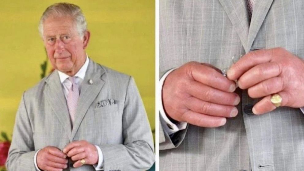 La misma inflamación también llamó la atención en mayo del año pasado, cuando el soberano se detuvo a tomar algo en un pub del sur de Londres.