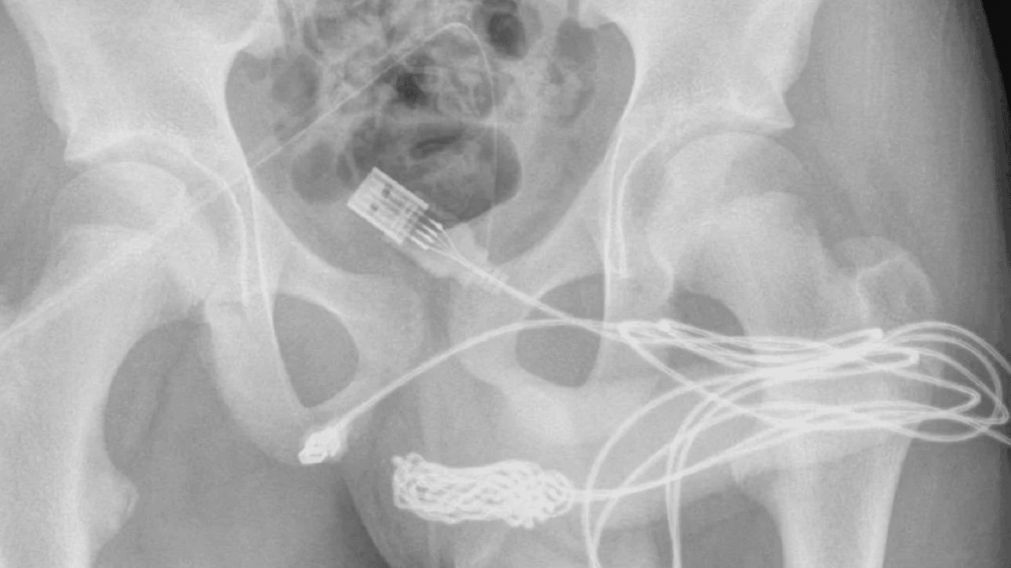 La radigrafía del adolescente que se metió un cable USB en el pene (ScienceDirect).
