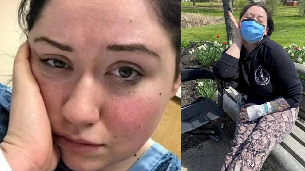 Tiene alergia a la gravedad y no puede estar de pie más de 3 minutos: el drama de una joven que impacta al mundo.