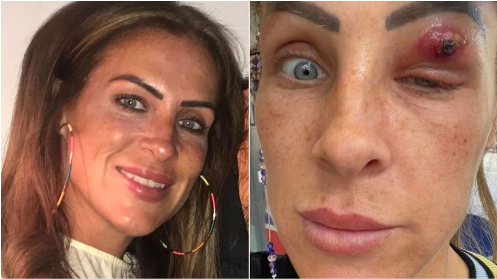 Le salió un grano enorme sobre el párpado, se tiró agua hirviendo y lo que pasó parece propio de una película de terror